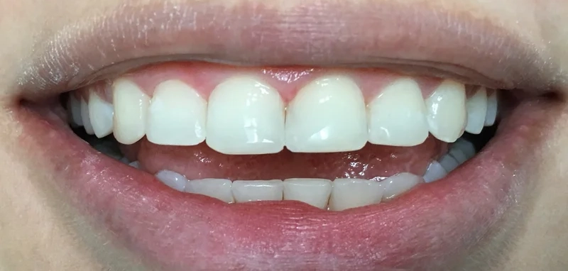 After anterior direct composite treatment