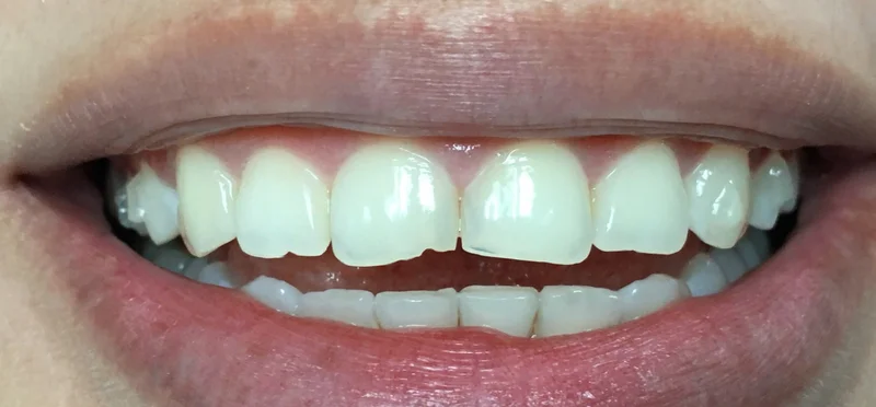 Before anterior direct composite treatment