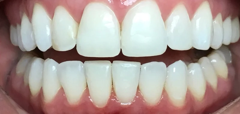 After anterior direct composite treatment