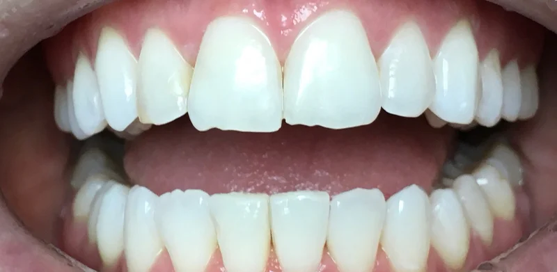 Before anterior direct composite treatment