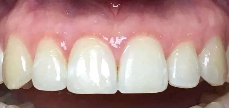 After anterior direct composite treatment