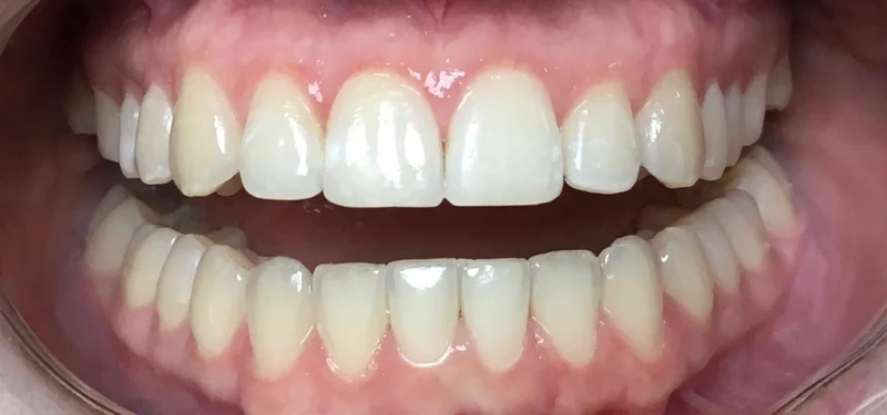 After anterior direct composite treatment
