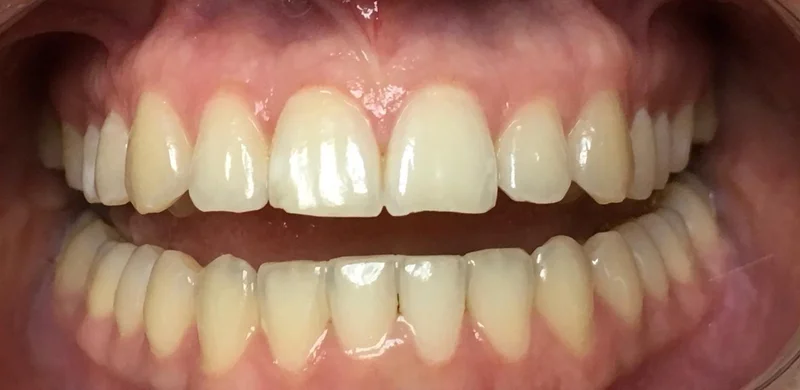 Before anterior direct composite treatment