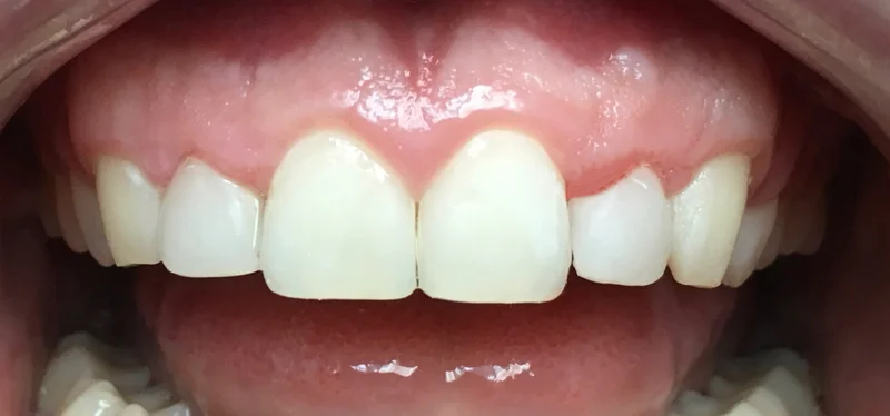 After anterior direct composite treatment