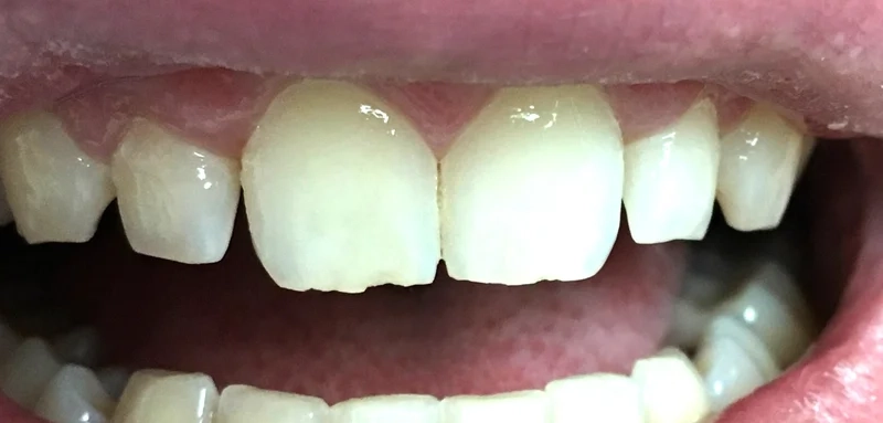 Before anterior direct composite treatment