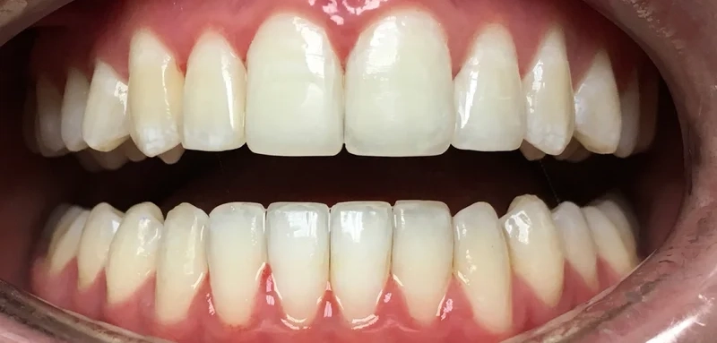 After anterior direct composite treatment