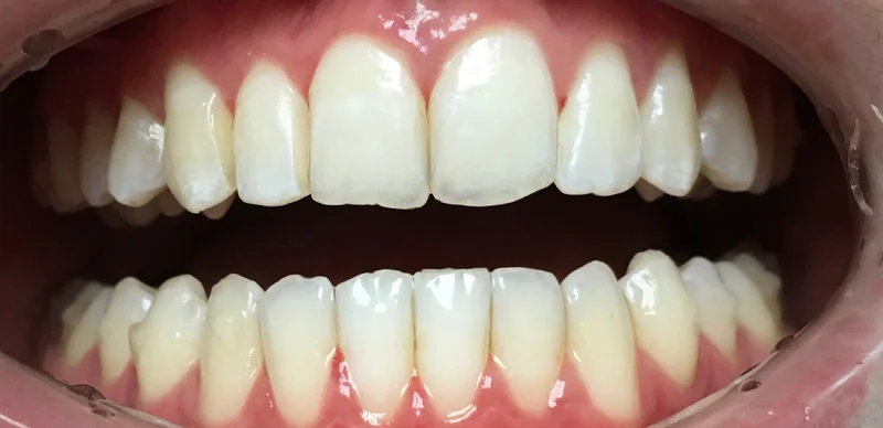 Before anterior direct composite treatment