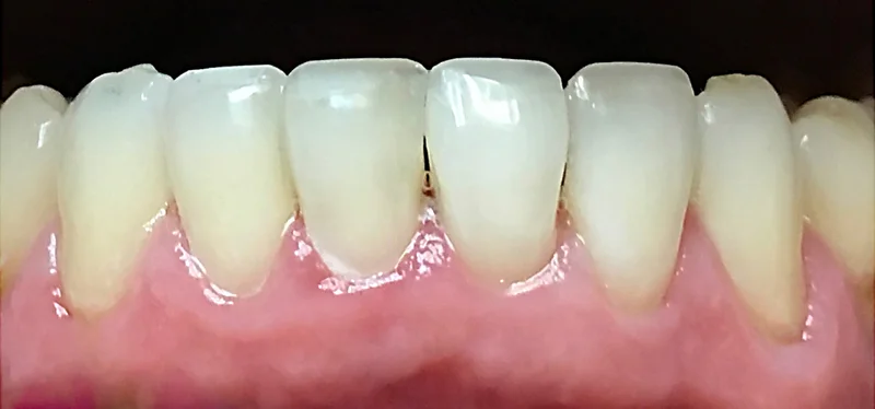 After anterior direct composite treatment