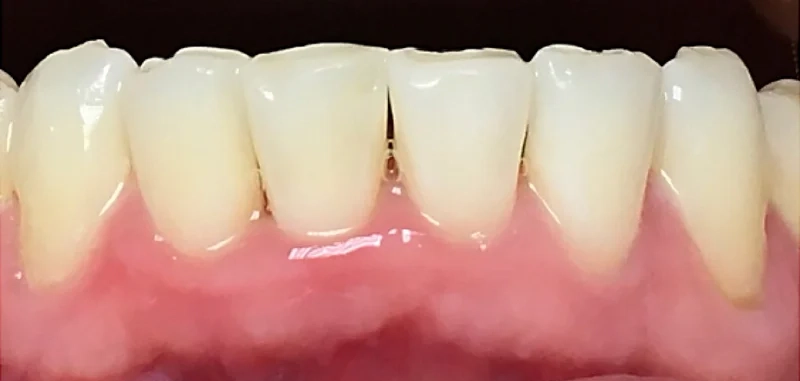 Before anterior direct composite treatment