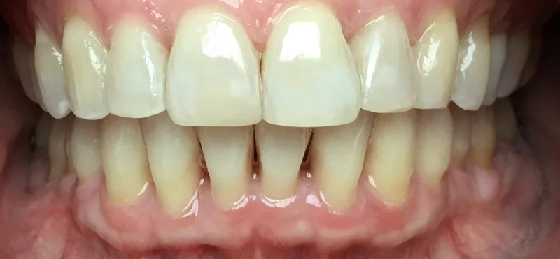 After anterior direct composite treatment