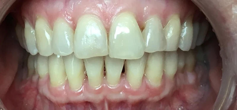 Before anterior direct composite treatment