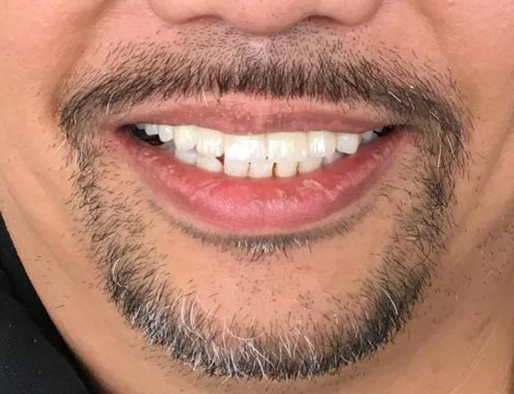 After bridge treatment