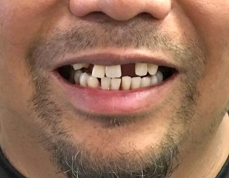 Before bridge treatment