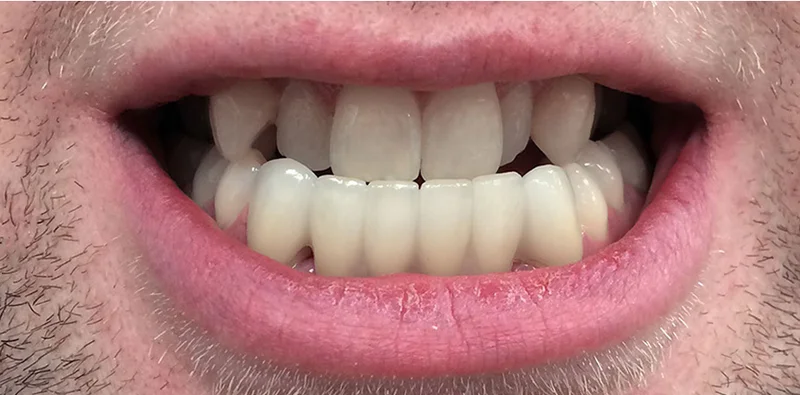 After bridge treatment