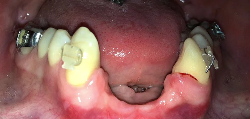 Before bridge treatment