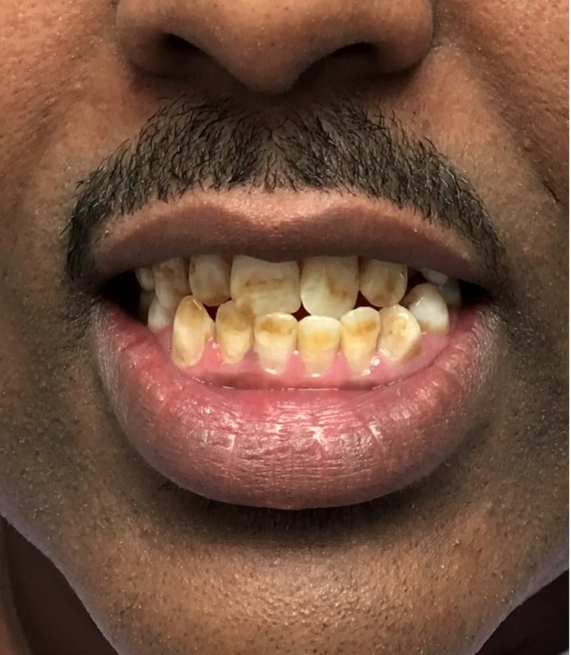 Before cosmetic work treatment