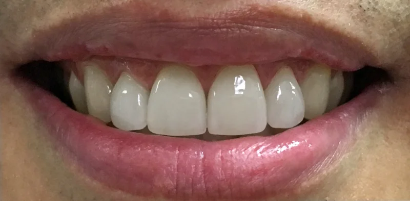 After cosmetic work treatment