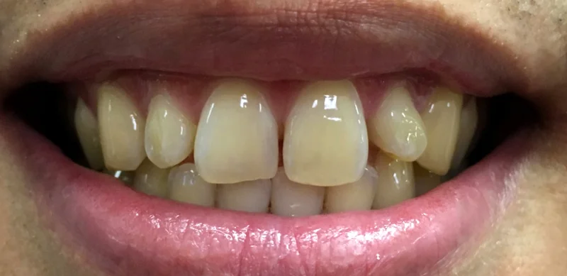 Before cosmetic work treatment