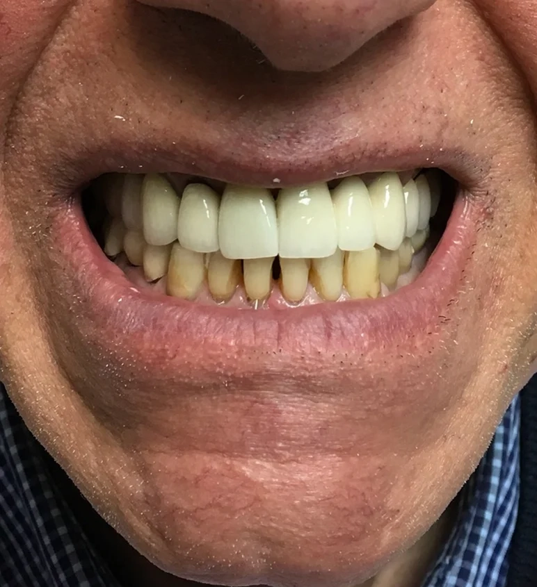 Before cosmetic work treatment