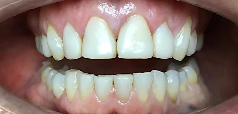 Before cosmetic work treatment