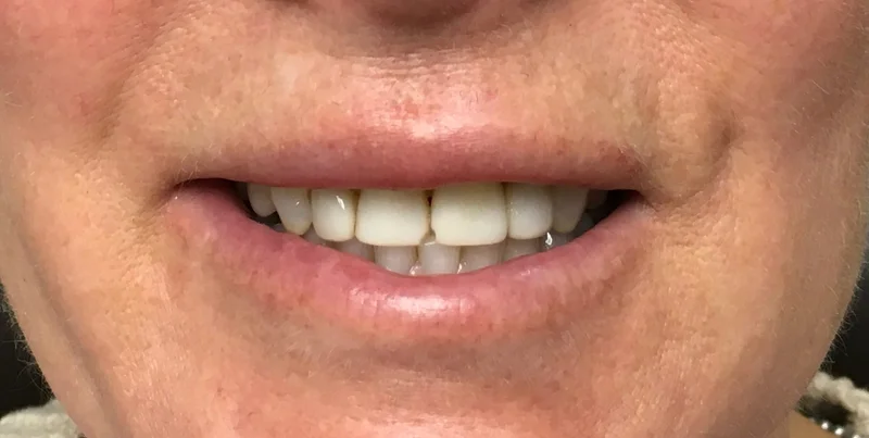 Before cosmetic work treatment