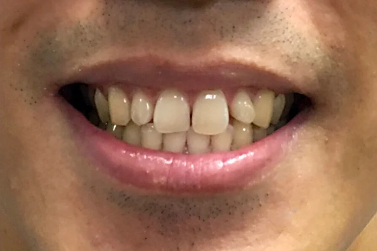 Before cosmetic work treatment