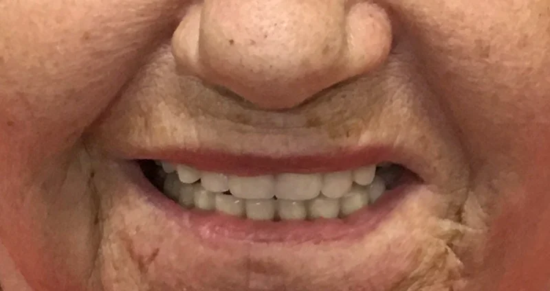 After denture treatment