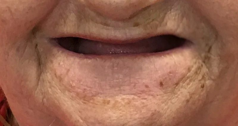 Before denture treatment