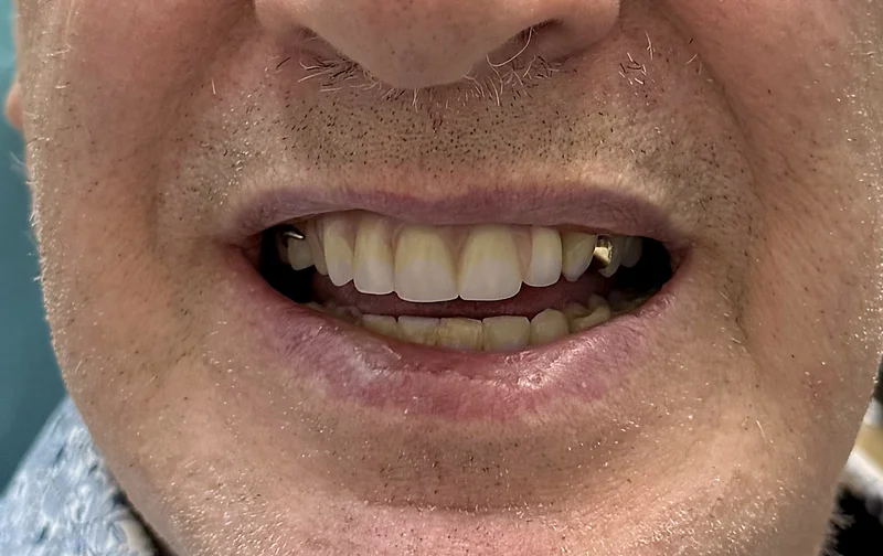 After denture treatment