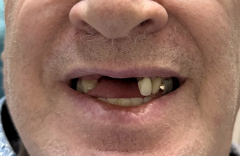 Before denture treatment