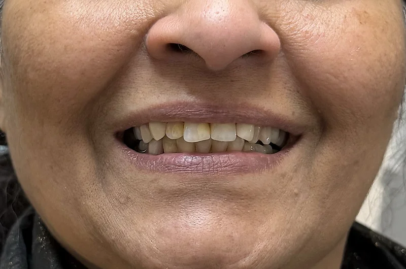 After denture treatment