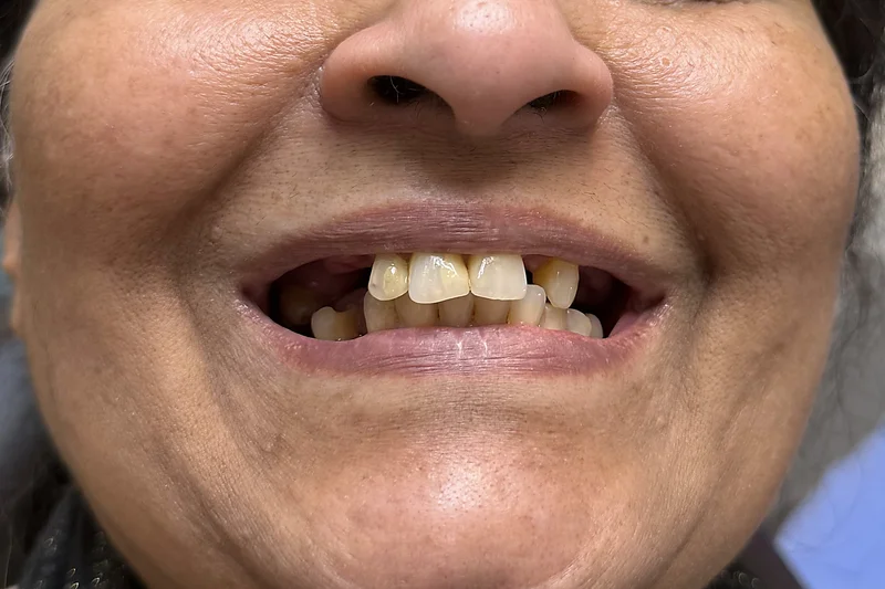 Before denture treatment