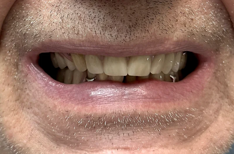 After denture treatment