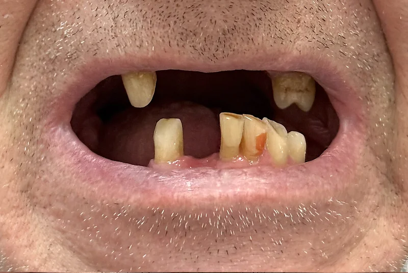 Before denture treatment