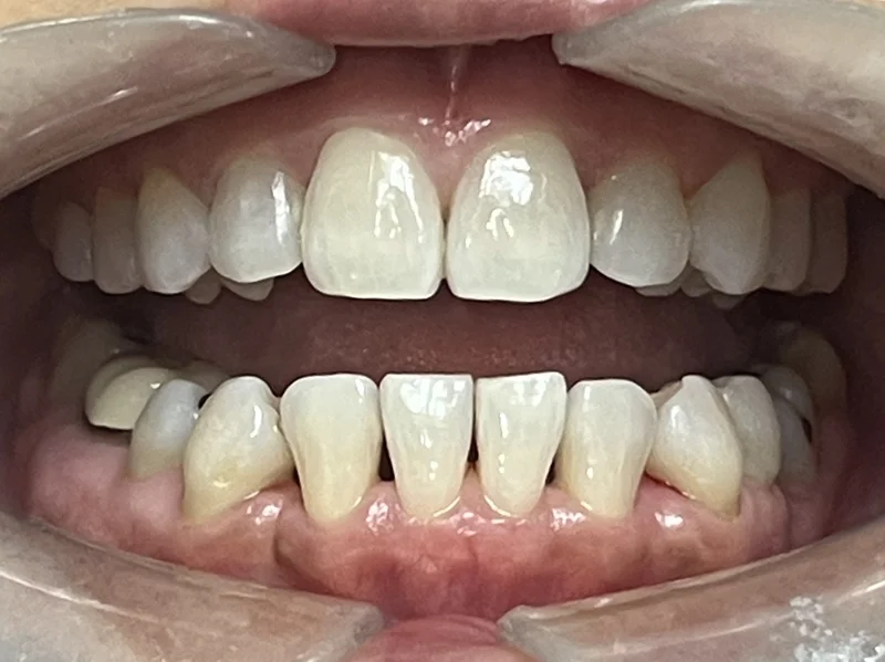 After invisalign treatment