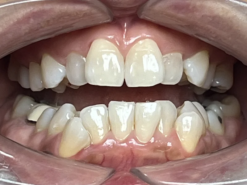 Before invisalign treatment