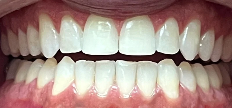 After invisalign treatment