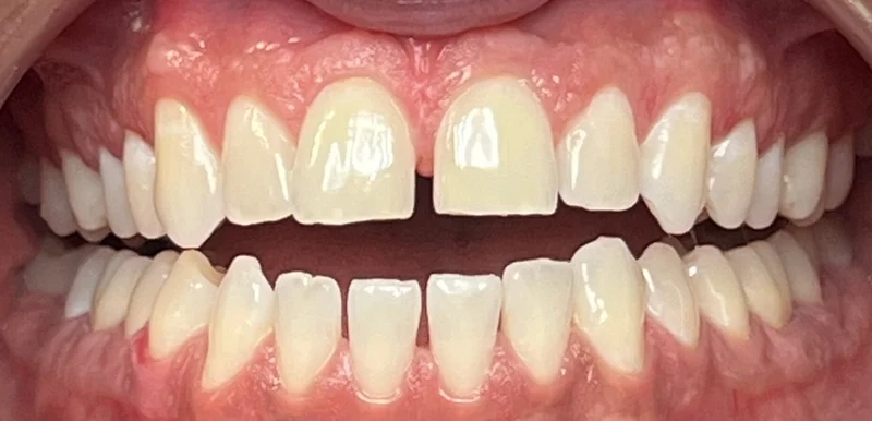 Before invisalign treatment