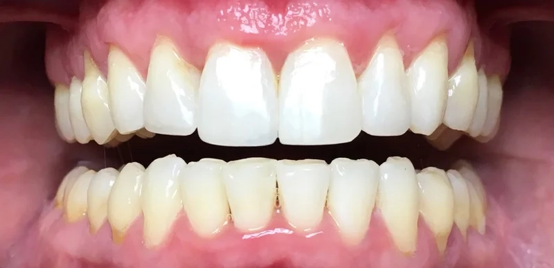 After invisalign treatment