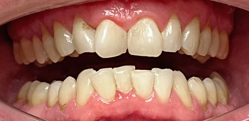 Before invisalign treatment