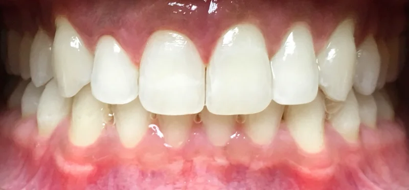 After invisalign treatment