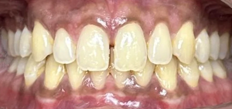 Before invisalign treatment