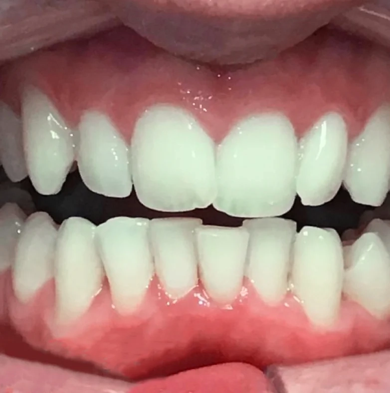 Before invisalign treatment