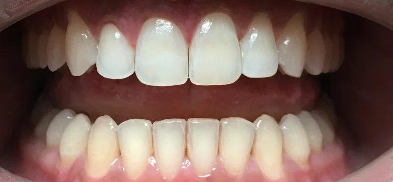 After invisalign treatment