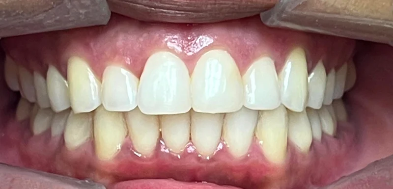 After invisalign treatment