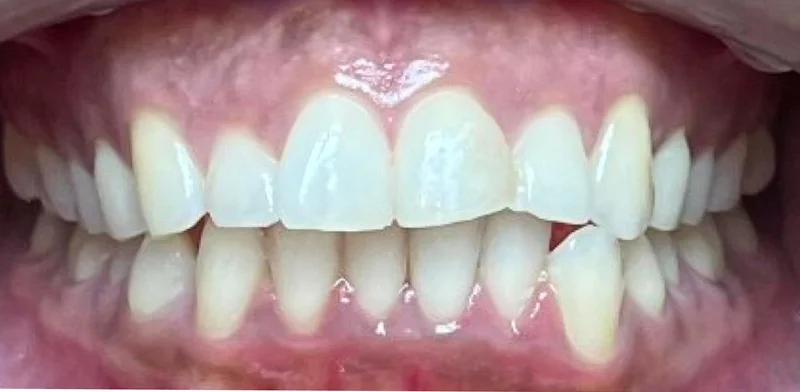 Before invisalign treatment