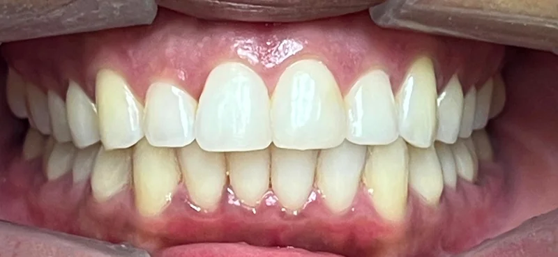 After invisalign treatment
