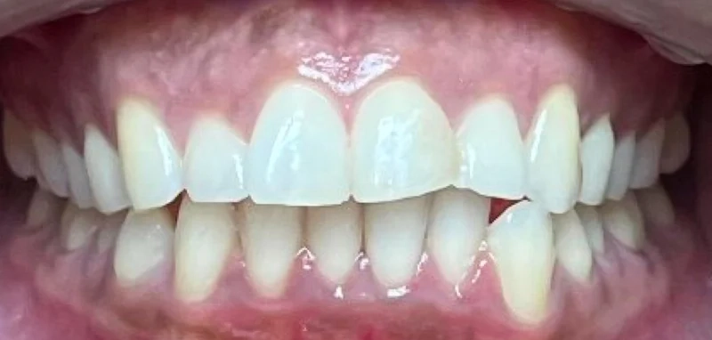 Before invisalign treatment