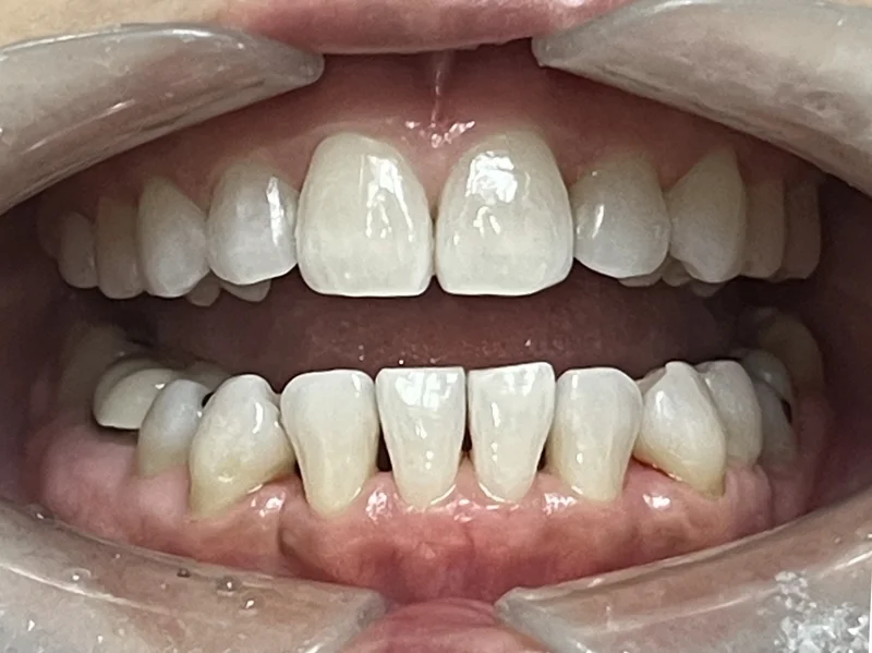 After ortho restoration treatment
