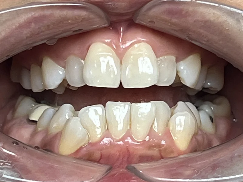 Before ortho restoration treatment